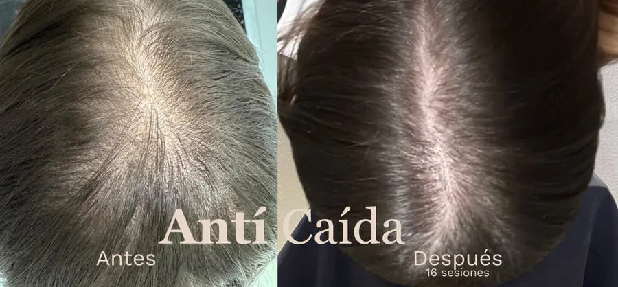 Anticaída capilar profesional antes y después — resultado real en BelaFios Maracaibo